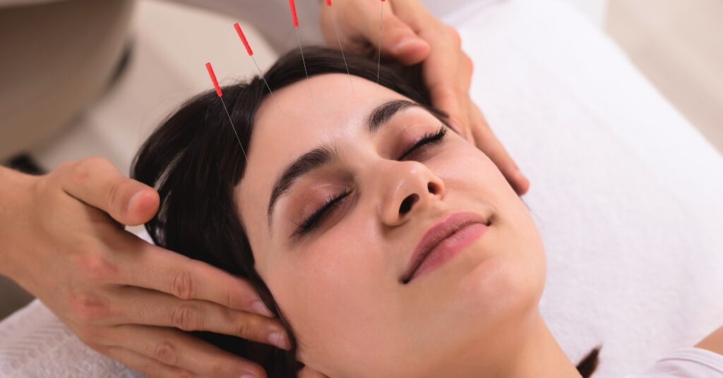 Mulher relaxada recebendo acupuntura facial para aliviar ansiedade e promover bem-estar.